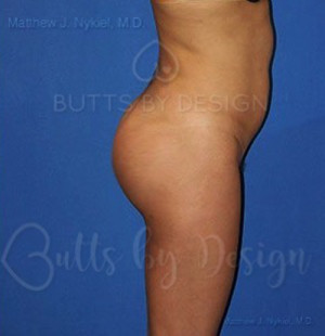 Butt Implant
