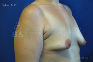 Breast Augmentation