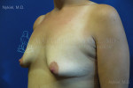 Breast Augmentation