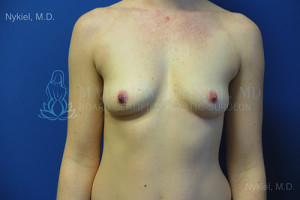 Breast Augmentation