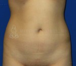 Liposuction