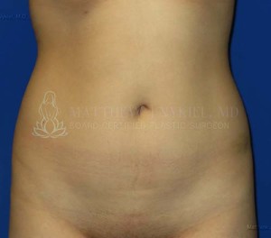 Liposuction