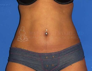 Liposuction