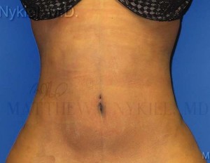 Liposuction