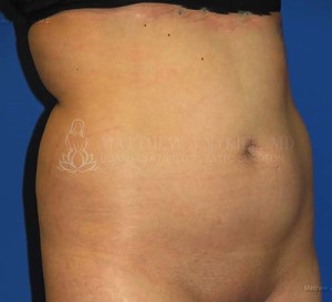 Liposuction