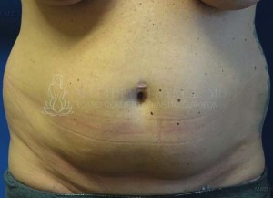 Liposuction