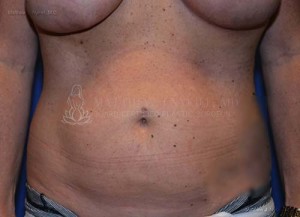 Liposuction