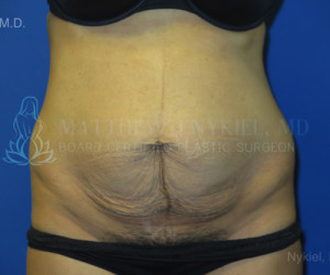 Tummy Tuck