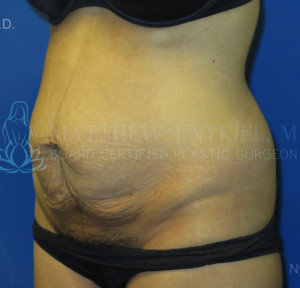 Tummy Tuck