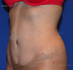 Tummy Tuck