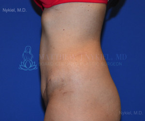 Tummy Tuck