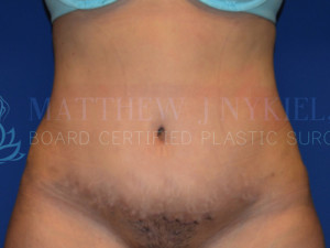 Tummy Tuck