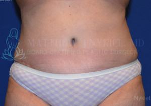 Tummy Tuck