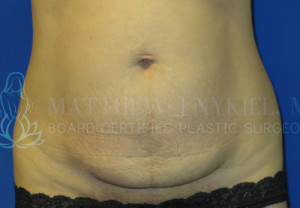 Tummy Tuck