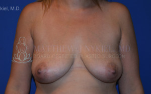 Breast Lift & Augmentation