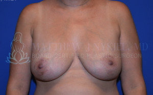 Breast Lift & Augmentation