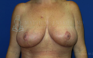 Breast Lift & Augmentation