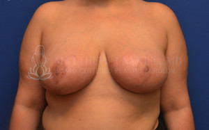 Breast Reduction