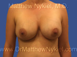 Breast Augmentation