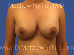 Breast Augmentation