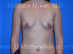 Breast Augmentation