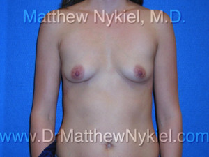 Breast Augmentation