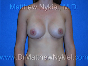 Breast Augmentation