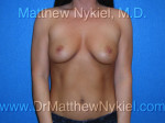 Breast Augmentation