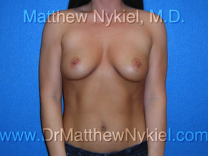 Breast Augmentation