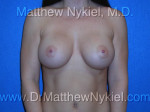 Breast Augmentation