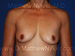 Breast Augmentation