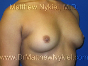 Breast Augmentation