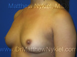 Breast Augmentation