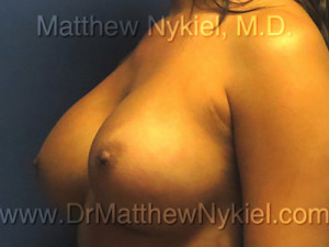 Breast Augmentation