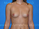 Breast Augmentation