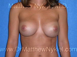 Breast Augmentation