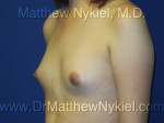 Breast Augmentation