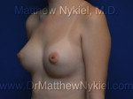 Breast Augmentation