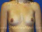 Breast Augmentation