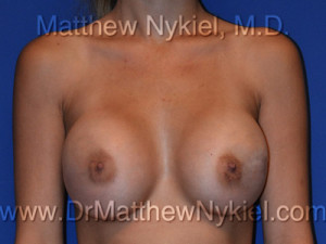 Breast Augmentation