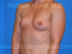 Breast Augmentation