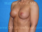 Breast Augmentation