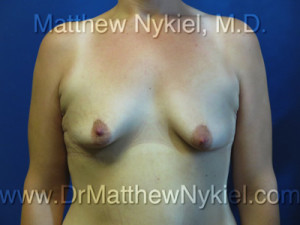 Breast Augmentation