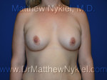 Breast Augmentation