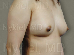 Fat Transfer to Breast