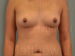 Fat Transfer to Breast