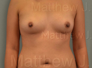 Fat Transfer to Breast