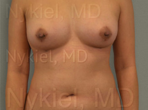 Fat Transfer to Breast