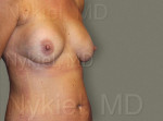 Fat Transfer to Breast