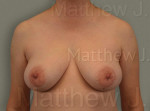 Fat Transfer to Breast